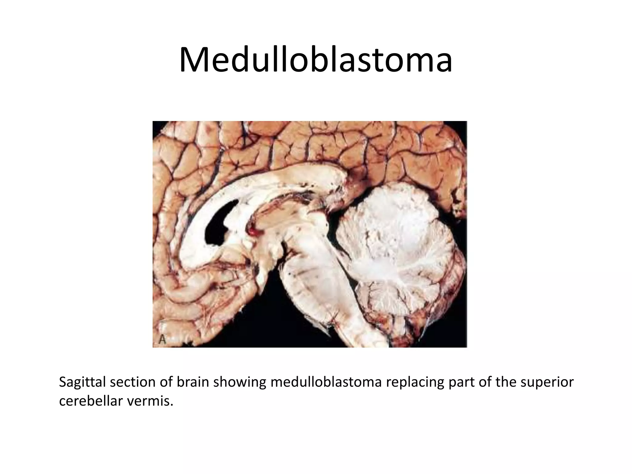 Medulloblastoma
Sagittal section of brain showing medulloblastoma replacing part of the superior
cerebellar vermis.
 
