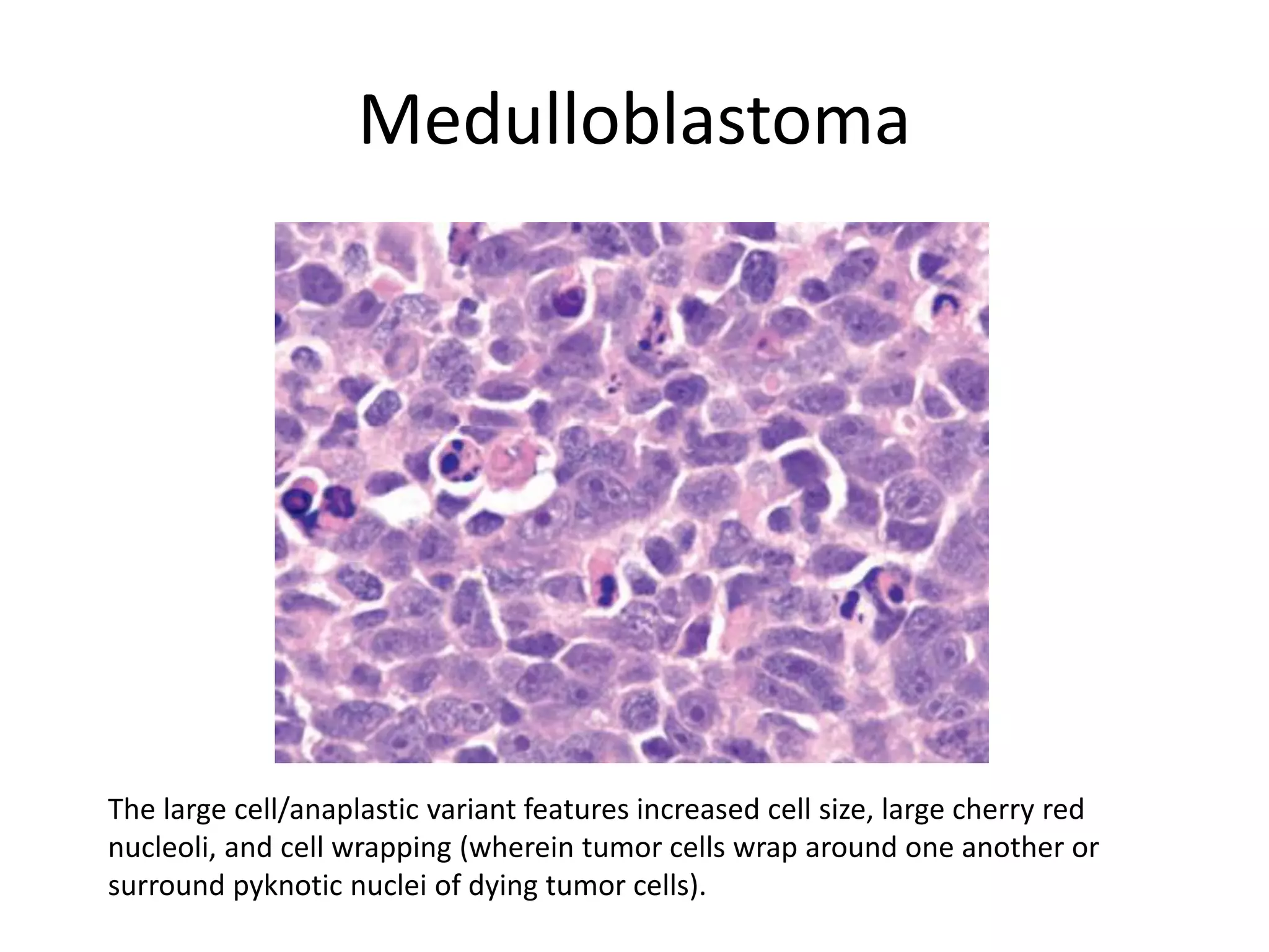 Medulloblastoma
The large cell/anaplastic variant features increased cell size, large cherry red
nucleoli, and cell wrapping (wherein tumor cells wrap around one another or
surround pyknotic nuclei of dying tumor cells).
 