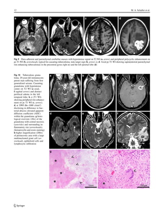 12 M. A. Schaller et al.
Fig. 9 Dura adherent and parenchymal cerebellar masses with hypointense signal on T2 WI (a, arrow) and peripheral polycyclic enhancement on
pc T1 WI (b, arrowhead), typical for caseating tuberculoma; note target sign (b, arrow). c, d: Axial pc T1 WI showing supratentorial parenchymal
rim enhancing tuberculomas in the precentral gyrus right (c) and the left parietal lobe (d)
Fig. 10 Tuberculous granu-
loma. 29-year-old immunocom-
petent man suffering from first
generalized seizure. Caseating
granuloma with hypointense
center on T2 WI (a axial,
f sagittal arrow) and distinct
perifocal edema in the left
temporal lobe; b, c (T1 WI)
showing peripheral rim enhance-
ment on pc T1 WI (c, arrow);
d, e: DWI (b= 1000 s/mm2
)
disclosing in difference to bac-
terial abscess elevated apparent
diffusion coefficient (ADC)
within the granuloma. g histo-
logical overview (20×) of the
granuloma with central necrosis
(asterisks) and surrounding in-
flammatory rim (arrowheads);
(hematoxylin and eosin staining)
h higher magnification (200×)
of perinecrotic area with a large
multinucleated giant cell (ar-
rowhead), epithelioid cells and
lymphocytic infiltration
K
 
