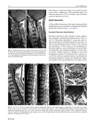 14 M. A. Schaller et al.
Fig. 12 Spinal tuberculosis in a young woman positive for HIV. Sag.
T1 WI (a, b) showing prevertebral (a, b: arrowhead) and epidural in-
flammatory masses with distinct enhancement on pc T1 WI (a, b: ar-
row). Note hypointense delineation of the dura mater (b) and involve-
ment of the intradural space
Fig. 13 Sag. pc T1 WI (a–c) demonstrating intradural tuberculous infection with inhomogeneous enhancement of the spinal cord surface
(a, b: arrow) as well as the radix (e: ax. pc T1 WI; arrow) and the cauda equina (c, arrow). Additional extravasation of contrast medium with
enhanced subarachnoid space (f, ax. pc T1 WI: white arrow; black arrow: anterior and posterior radix); d (sag. T2 WI): longitudinal extensive
transverse myelitis with hyperintense signal changes (arrow) of the enlarged spinal cord and additional syrinx (arrowhead) due to arachnoid
adhesion with impairment of CSF flow
brain abscess is much more likely to be caused by strep-
tococci (34%), staphylococci (18%) and other agents, my-
cobacteria being rare (0.7%) according to the systematic
review by Brouwer et al. [91].
Spinal Tuberculosis
A TB can affect all structures of the spine. Anatomically the
manifestations can be classified as extradural and intradural
(tuberculous infections; Figs. 12, 13 and 14).
Extradural Tuberculous Spinal Infection
Extradural tuberculous spinal infection includes tubercu-
lous spondylitis, paraspinal and epidural abscess (Figs. 12
and 14). Tuberculous spondylitis is among the most fre-
quent manifestations of skeletal tuberculosis ([92]; Fig. 14)
and was first described by Percival Pott in 1779. The clin-
ical presentation of Pott’s disease is the development of
back pain, kyphosis, sensory disturbances, bowel and blad-
der dysfunction and eventually paraparesis over the course
of months. Vertebral infection is thought to result from
hematogenous spread of mycobacteria from a primary fo-
cus [93]. In contrast to pyogenic bacteria, mycobacteria do
not produce proteolytic enzymes that degrade the collage-
nous annulus of the intervertebral discs. In children, where
K
 