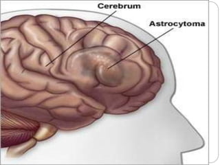 Central nervous system tumors | PPTX