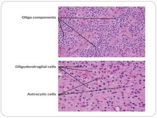 Central nervous system tumors | PPTX