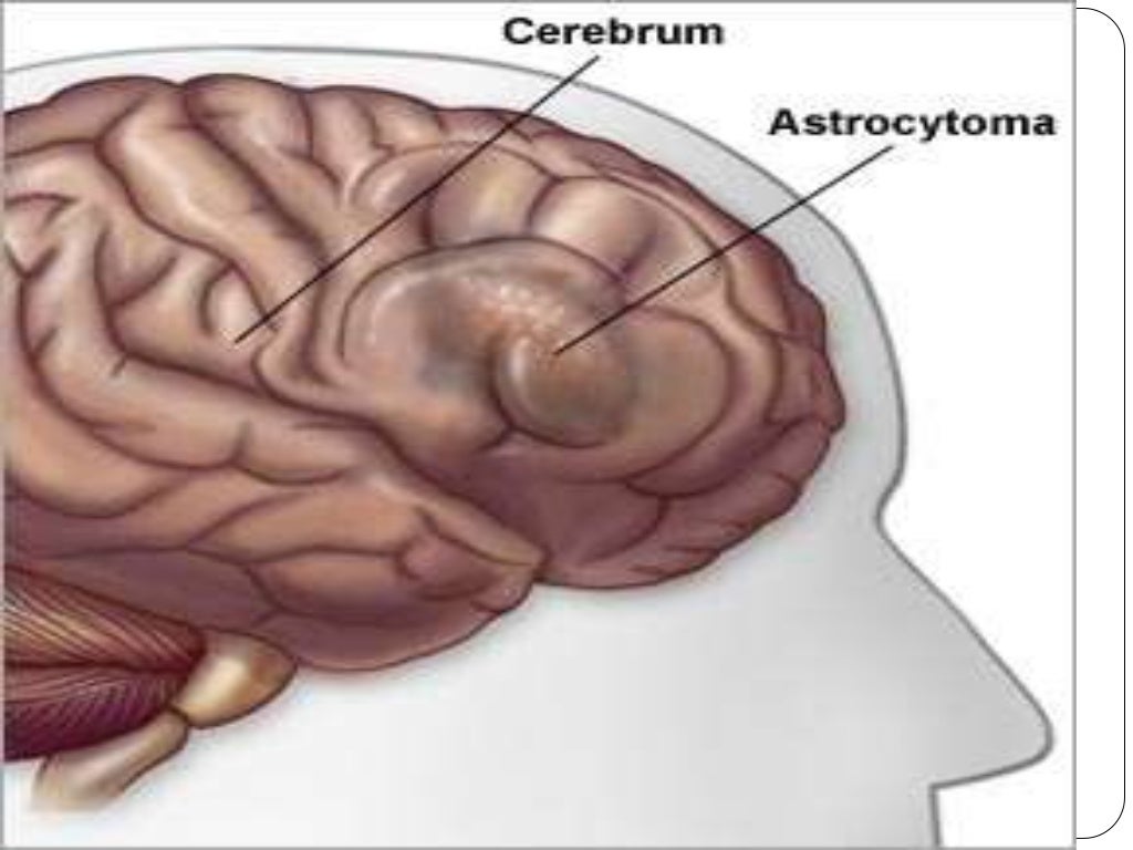 Central Nervous System Tumors