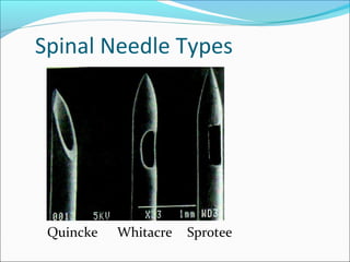Spinal Needle Types
Quincke Whitacre Sprotee
 