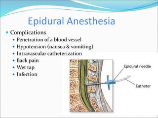 Epidural Anesthesia
 Complications
 Penetration of a blood vessel
 Hypotension (nausea & vomiting)
 Intravascular catheterization
 Back pain
 Wet tap
 Infection
 