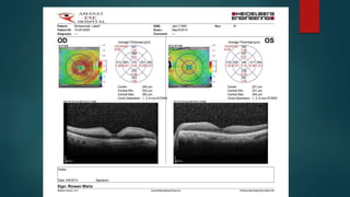 Central retinal artery occlusion | PDF