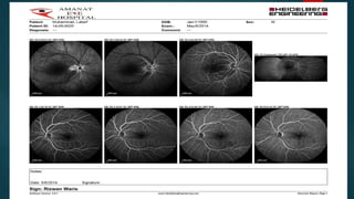 Central retinal artery occlusion | PDF