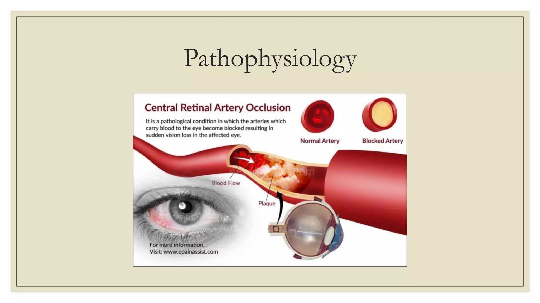 Central Retinal Artery Occlusion | PPTX