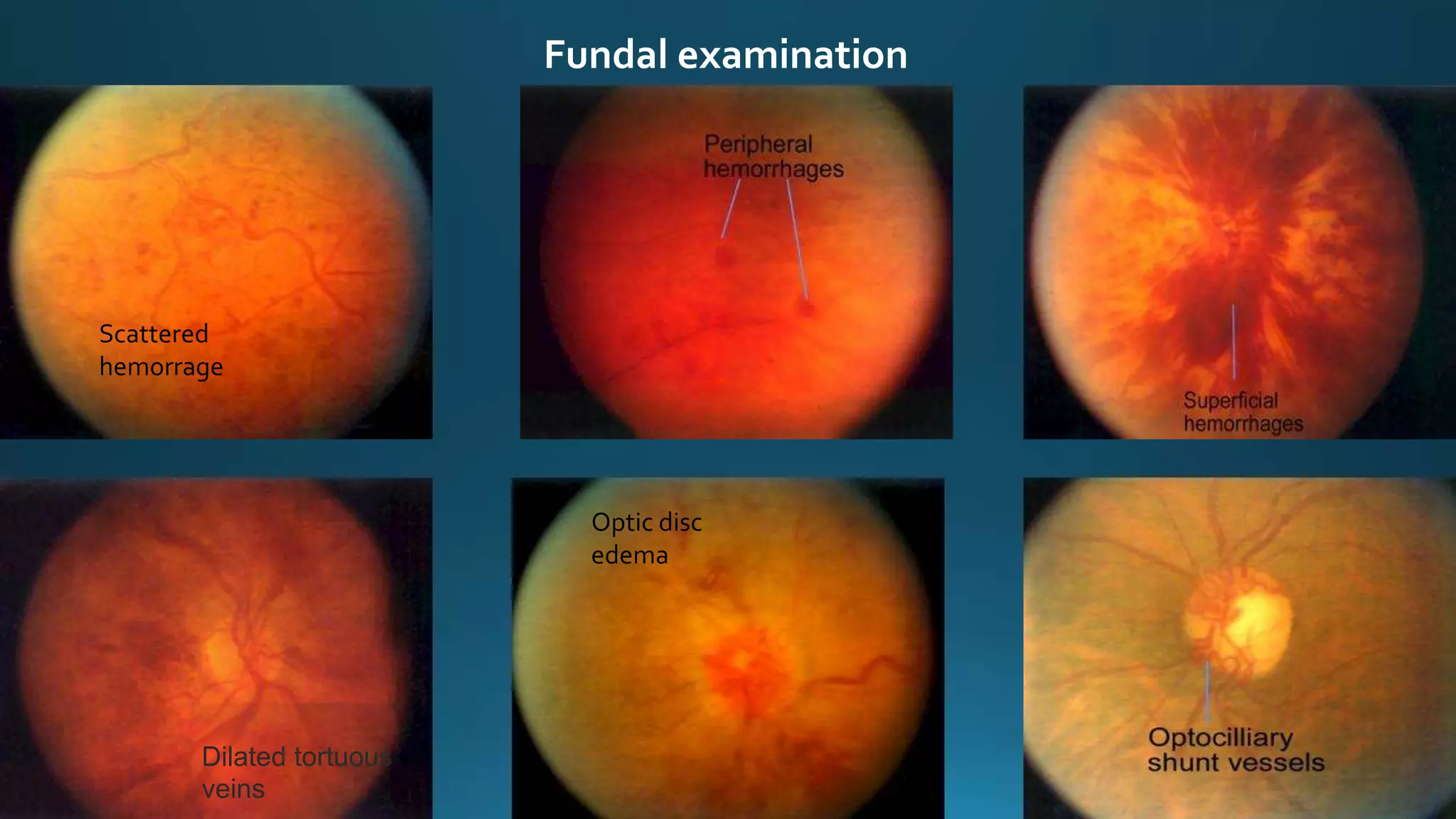 Central Retinal Vein Occlusion CRVO PPTX