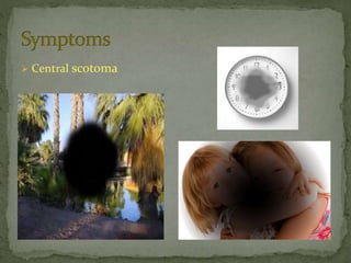 Central Serous Retinopathy Vision
