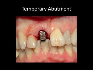 Immediate Implant Placement and Temporization | PDF