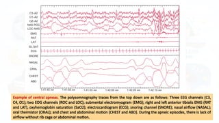 Mixed Apnea Example Comprehensive Overview of Central and Mixed Sleep Apnea: Diagnosis ...