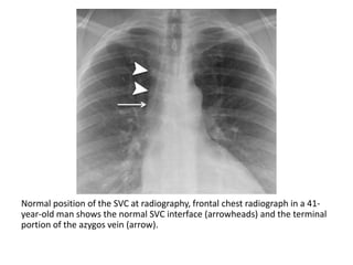 Central Venous Access.pptx