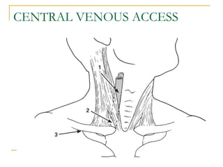 CENTRAL VENOUS ACCESS
 