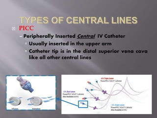 CENTRAL VENOUS CATHETER | PPTX