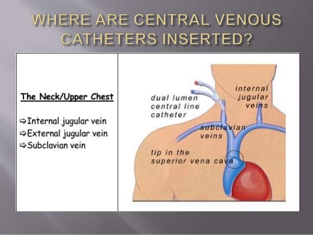 Central Venous Catheter Locations