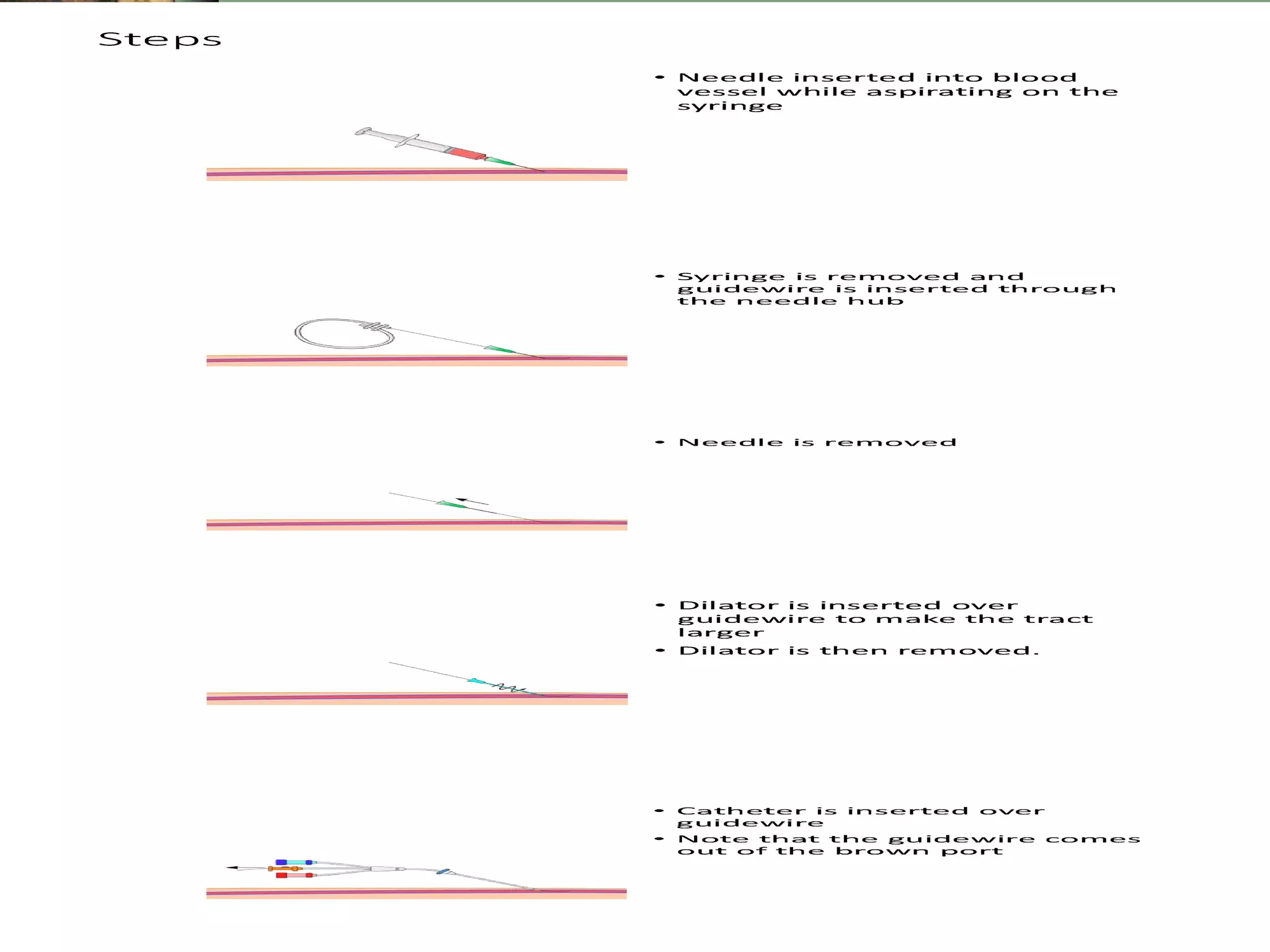 Central venous catheterisation | PPT
