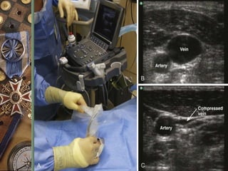 Central venous catheterisation | PPT