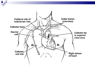 Central venous catheterization | PPT