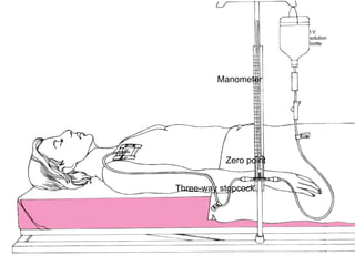 I.V.
                        solution
                        bottle




         Manometer




           Zero point


Three-way stopcock
 