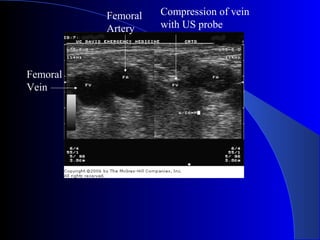 Femoral
Vein
Femoral
Artery
Compression of vein
with US probe
 