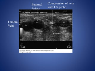 Central venous catheterization | PPTX
