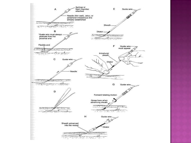 Central venous catheterization | PPT | First Aid | Injuries