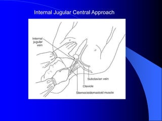 Internal Jugular Central Approach
 