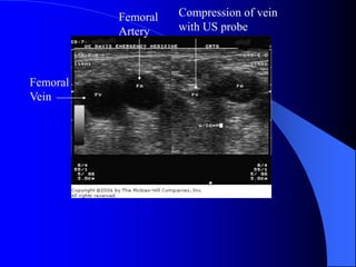 Femoral
Vein
Femoral
Artery
Compression of vein
with US probe
 