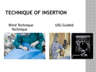 TECHNIQUE OF INSERTION
Blind Technique USG Guided
Technique
 