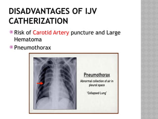 DISADVANTAGES OF IJV
CATHERIZATION
 Risk of Carotid Artery puncture and Large
Hematoma
 Pneumothorax
 
