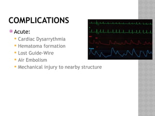 COMPLICATIONS
 Acute:
 Cardiac Dysarrythmia
 Hematoma formation
 Lost Guide-Wire
 Air Embolism
 Mechanical injury to nearby structure
 