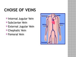 CHOISE OF VEINS
 Internal Jugular Vein
 Subclavian Vein
 External Jugular Vein
 Chephalic Vein
 Femoral Vein
Subclavian
 