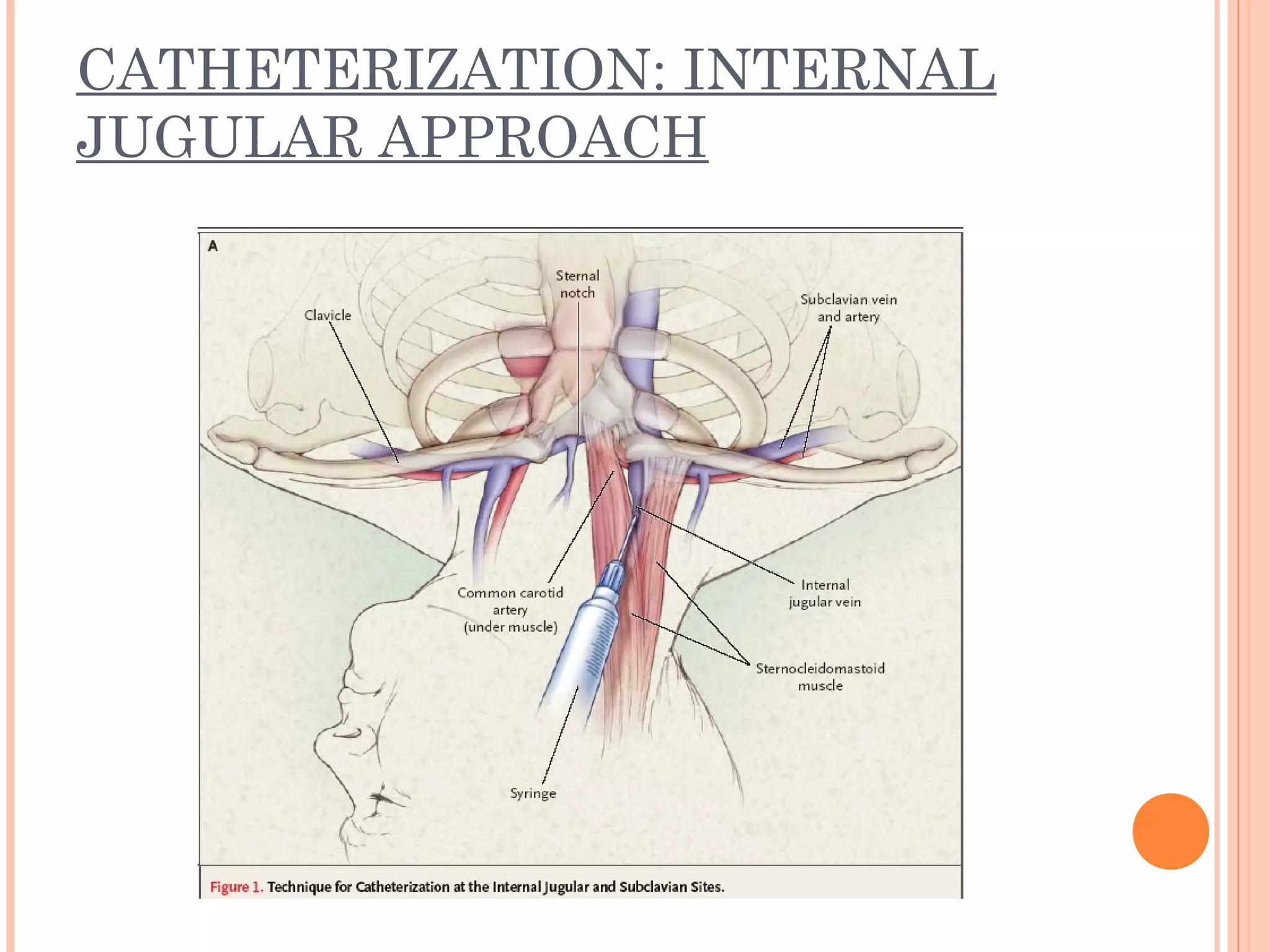CATHETERIZATION: INTERNAL
JUGULAR APPROACH
 