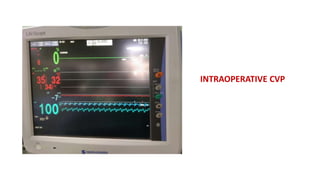 INTRAOPERATIVE CVP
 