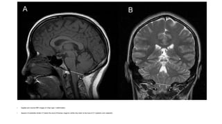 • Sagittal and coronal MRI images of Chiari type I malformation.
• descent of cerebellar tonsils (T) below the level of foramen magnum (white line) down to the level of C1 posterior arch (asterisk).
 