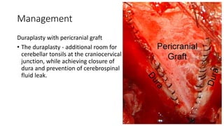 Management
Duraplasty with pericranial graft
• The duraplasty - additional room for
cerebellar tonsils at the craniocervical
junction, while achieving closure of
dura and prevention of cerebrospinal
fluid leak.
 