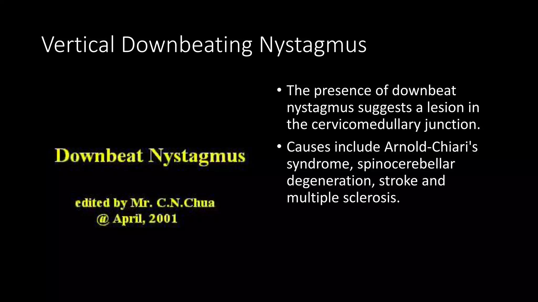 Central vertigo and nystagmus | PPTX