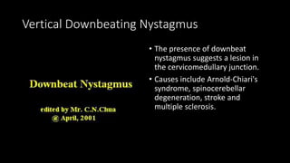 Vertical Downbeating Nystagmus
• The presence of downbeat
nystagmus suggests a lesion in
the cervicomedullary junction.
• Causes include Arnold-Chiari's
syndrome, spinocerebellar
degeneration, stroke and
multiple sclerosis.
 