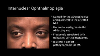 Internuclear Ophthalmoplegia
• Named for the ADducting eye
and ipsilateral to the affected
MLF
• Horizontal nystagmus in the
ABducting eye
• Frequently associated with
upbeating vertical nystagmus
• Bilateral is almost
pathognomonic for MS
 