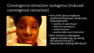 Convergence-retraction nystagmus (induced
convergence-retraction)
• Part of the dorsal midbrain
syndrome (Piranaud’s Syndrome)
associated with:
• paralysis of upward gaze
• defective convergence
• eyelid retraction
• pupillary light–near dissociation
• Best elicited on attempted
upgaze saccades (eg, by asking
the patient to track a
downwardly rotating OKN drum)
 