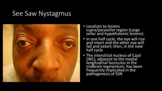 See Saw Nystagmus
• Localizes to lesions
supra/parasellar region (Large
sellar and hypothalamic lesions)
• In one half cycle, the eye will rise
and intort and the other eye will
fall and extort; then, in the next
half cycle
• The interstitial nucleus of Cajal
(INC), adjacent to the medial
longitudinal fasciculus in the
midbrain tegmentum, has been
frequently implicated in the
pathogenesis of SSN
 