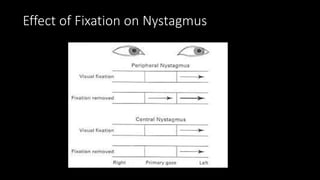 Effect of Fixation on Nystagmus
 