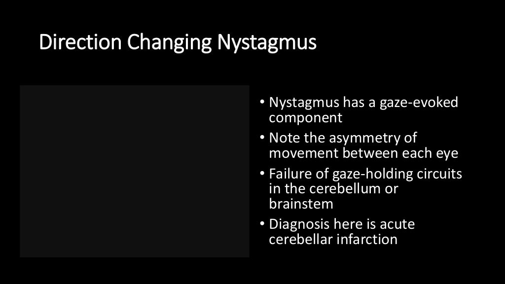 Central vertigo and nystagmus