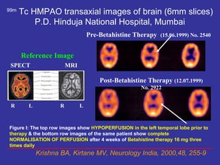 99m
      Tc HMPAO transaxial images of brain (6mm slices)
          P.D. Hinduja National Hospital, Mumbai
                                  Pre-Betahistine Therapy (15.06.1999) No. 2540


      Reference Image
 SPECT                  MRI

                                      Post-Betahistine Therapy (12.07.1999)
                                                      No. 2922


 R      L           R         L


Figure I: The top row images show HYPOPERFUSION in the left temporal lobe prior to
therapy & the bottom row images of the same patient show complete
NORMALISATION OF PERFUSION after 4 weeks of Betahistine therapy 16 mg three
times daily
            Krishna BA, Kirtane MV, Neurology India, 2000,48, 255-9
 