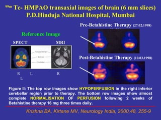 99m
      Tc- HMPAO transaxial images of brain (6 mm slices)
          P.D.Hinduja National Hospital, Mumbai
                                      Pre-Betahistine Therapy (27.02.1998)
                                                     No.791
           Reference Image
      SPECT                 MRI


                                      Post-Betahistine Therapy (10.03.1998)
                                                     No. 1950


       R        L           R
           L

 Figure II: The top row images show HYPOPERFUSION in the right inferior
 cerebellar region prior to therapy. The bottom row images show almost
 complete NORMALISATION OF PERFUSION following 2 weeks of
 Betahistine therapy 16 mg three times daily.

               Krishna BA, Kirtane MV, Neurology India, 2000,48, 255-9
 