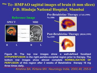 99m
      Tc- HMPAO sagittal images of brain (6 mm slices)
         P.D. Hinduja National Hospital, Mumbai
                                      Pre-Betahistine Therapy (17.03.1999)
        Reference Image               No.1086

      SPECT                 MRI



                                      Post-Betahistine Therapy (08.04.1999)
                                      No.1599


  R           L         R         L


 Figure III: The top row images show a well-defined focalized
 HYPOPERFUSION in the right parieto-occipital region prior to therapy. The
 bottom row images show almost complete NORMALISATION OF
 PERFUSION of this region after 3 weeks of Betahistine therapy 16 mg
 three times daily.
              Krishna BA, Kirtane MV, Neurology India, 2000,48, 255-9
 