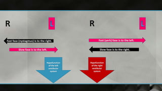 Hypofunction
of the left
vestibular
system
Fast fase (nystagmus) is to the right.
Slow fase is to the left.
Hypofunction
of the right
vestibular
system
Fast (yerk) fase is to the left.
Slow fase is to the right.
 