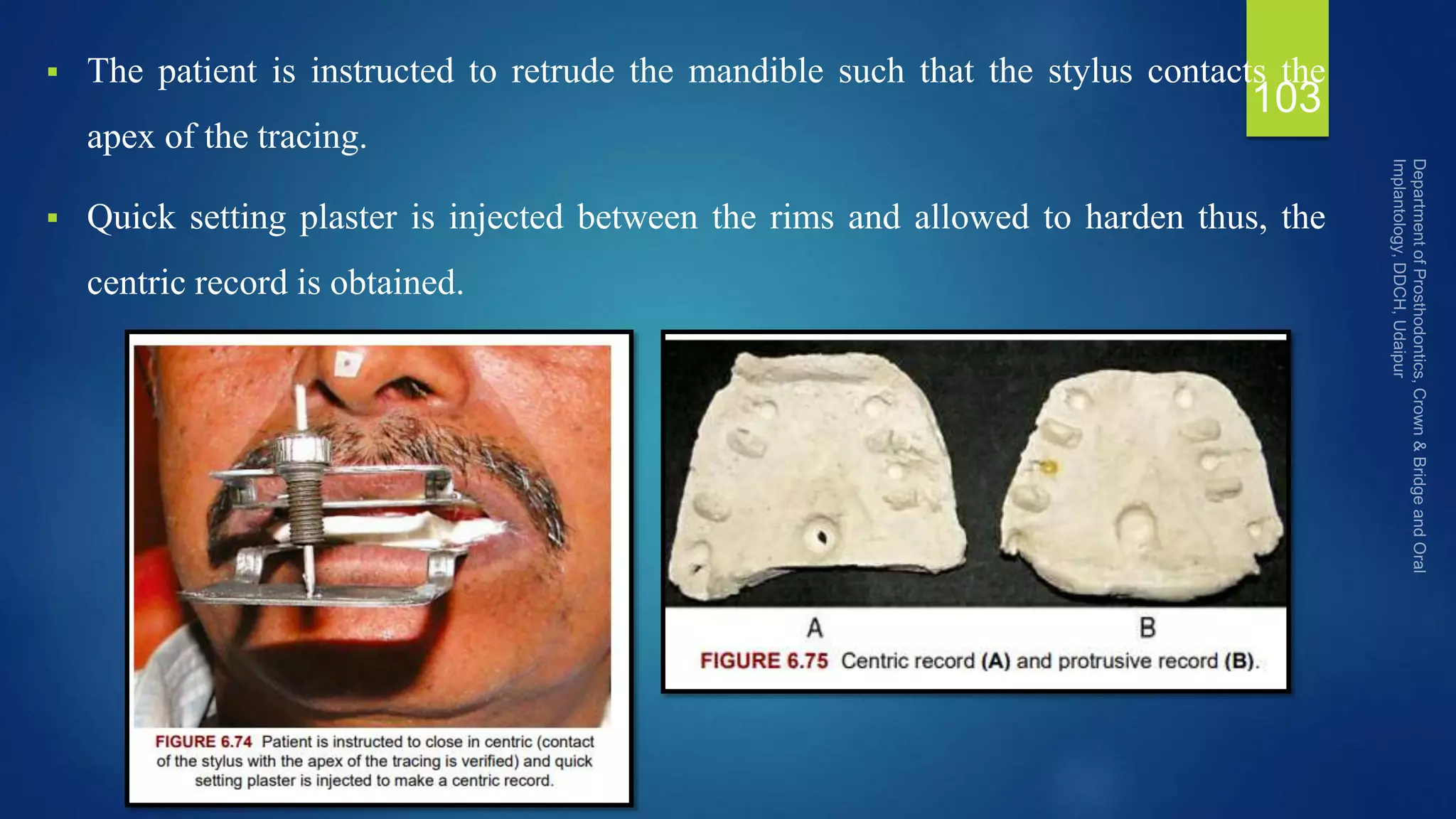  The patient is instructed to retrude the mandible such that the stylus contacts the
apex of the tracing.
 Quick setting plaster is injected between the rims and allowed to harden thus, the
centric record is obtained.
103
 