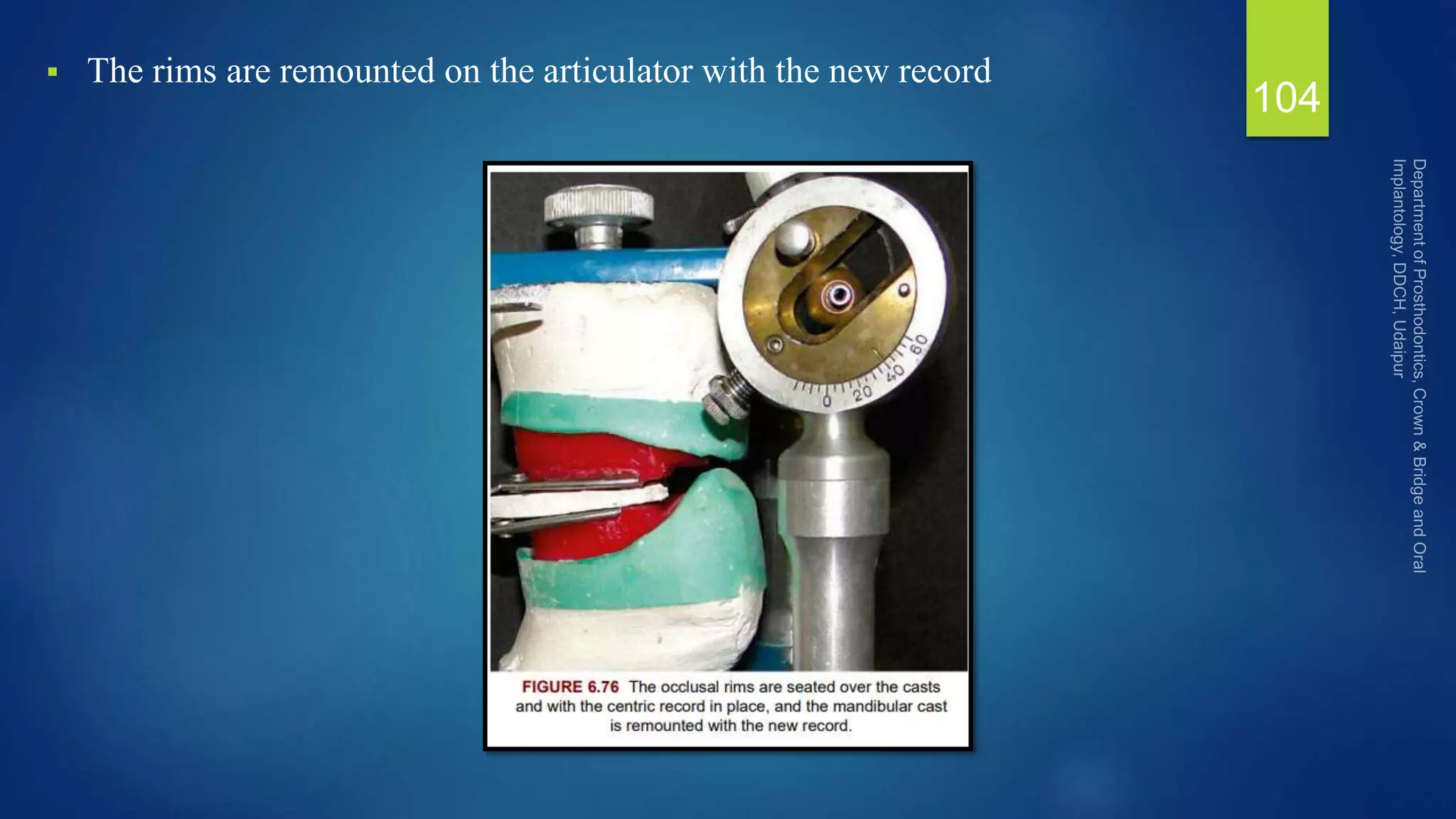  The rims are remounted on the articulator with the new record
104
 